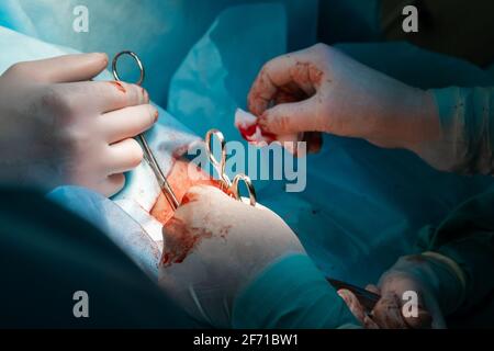 The bloody hands of surgeons in sterile gloves work with a medical instrument during a surgical operation. Stock Photo