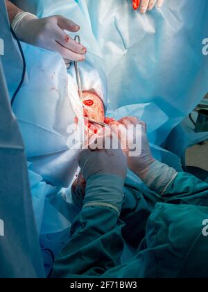 The bloody hands of surgeons in sterile gloves work with a medical instrument during a surgical operation. Stock Photo