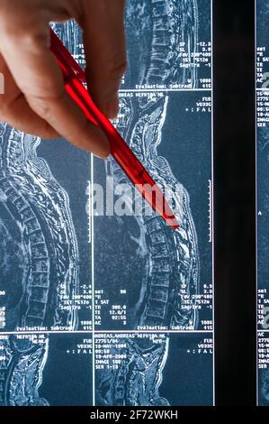 Magnetic resonance imaging, MRI, computed tomography, x-ray image. Cross section of the spine Stock Photo