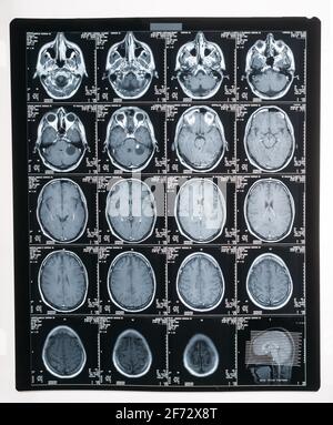 magnetic-resonance-imaging-mri