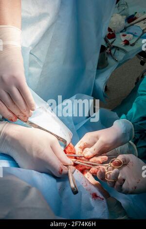 The bloody hands of surgeons in sterile gloves work with a medical instrument during a surgical operation. Stock Photo