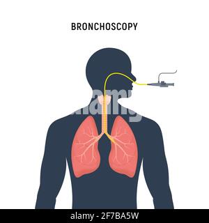 Bronchoscopy respiratory system emphysema endoscopy human lung examination. Bronchoscopy icon Stock Vector