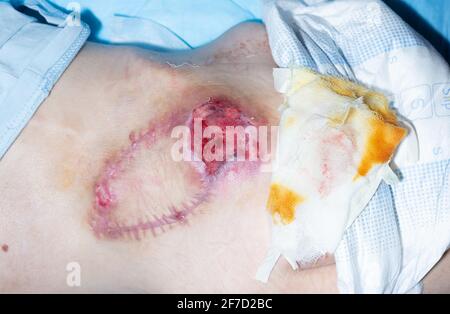 bedsores of the second degree sacrococcygeal region after surgery for plastic skin pressure sores. Stock Photo