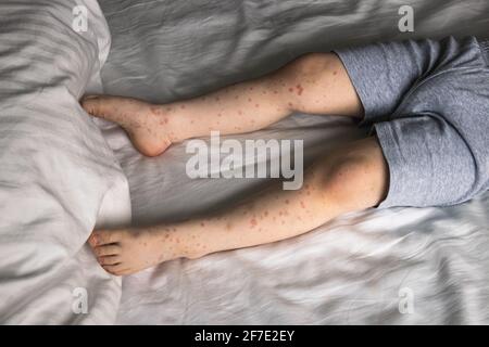 Child with skin rash, roseola, Hand-foot-and-mouth disease, child rash ...