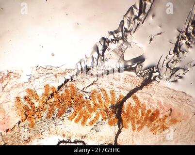 Pinworms eggs Enterobius vermicularis in stool examination under ...