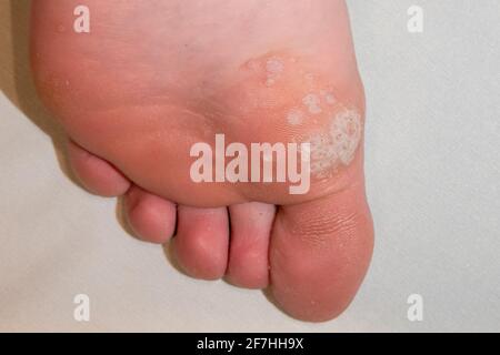 Sole of foot showing mosaic plantar wart and other verrucas including the black spot clotted blood vessel centres Stock Photo