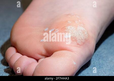 Sole of foot showing salicylic acid treatment of mosaic plantar wart and other verrucas Stock Photo