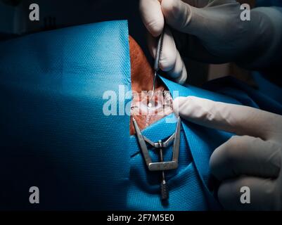 basra, Iraq - april 8, 2021:  surgeon scrubbing the corneal epithelium forPRK operation of the eye Stock Photo