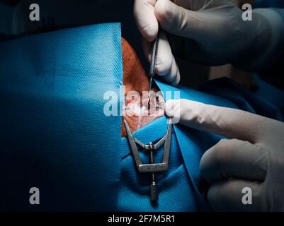 basra, Iraq - april 8, 2021:  surgeon scrubbing the corneal epithelium forPRK operation of the eye Stock Photo