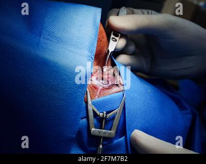 basra, Iraq - april 8, 2021:  surgeon putting contact lets on the cornea post PRK operation Stock Photo