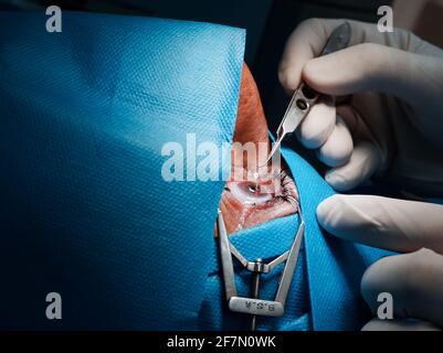 basra, Iraq - april 8, 2021:  surgeon putting contact lets on the cornea post PRK operation Stock Photo