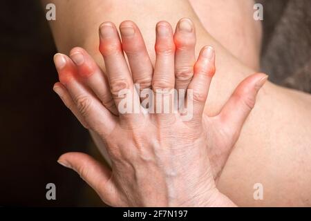 Elderly woman's hands with sore fingers. Finger treatment concept. Stock Photo