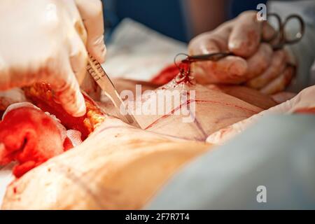 Doctors performing abdominoplasty surgery in the hospital. Focus on male plastic surgeon doing abdominal plastic surgery in operating room. Concept of Stock Photo