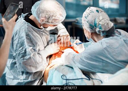 Doctors performing abdominoplasty surgery in the hospital. Focus on male plastic surgeon doing abdominal plastic surgery in operating room. Concept of Stock Photo