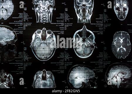 Magnetic resonance imaging of the brain close up. MRI Stock Photo - Alamy