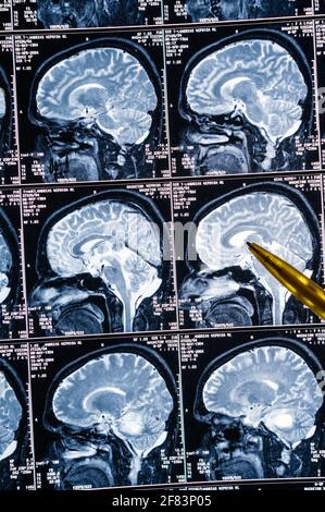 Magnetic resonance imaging, MRI, computed tomography, x-ray