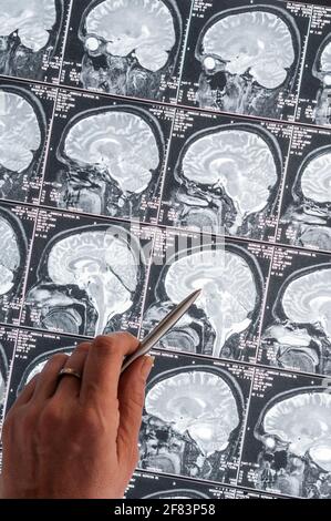 Magnetic resonance imaging, MRI, computed tomography, x-ray image. Head with brain in lateral cross-section Stock Photo