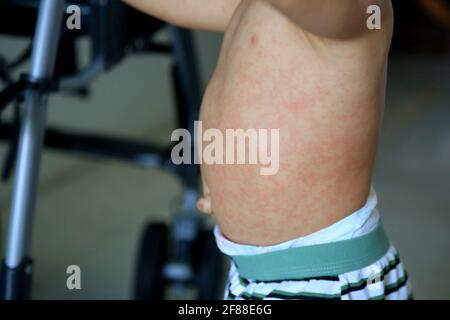 salvador, bahia / brazil - february 14, 2017: Child with measles symptoms is seen with small red spots on body and feverish state. *** Local Caption * Stock Photo