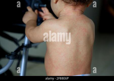 salvador, bahia / brazil - february 14, 2017: Child with measles symptoms is seen with small red spots on body and feverish state. *** Local Caption * Stock Photo