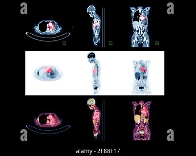 PET Scan image of whole body Comparison Axial , Coronal and Sagittal plane for detect cancer recurrence after surgery. medical technology concept. Stock Photo