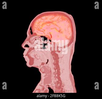 colorful of CT angiography of the brain or CTA brain Sagittal view ...