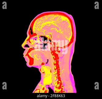 Colorful Of Ct Angiography Of The Brain Or Cta Brain Sagittal View 