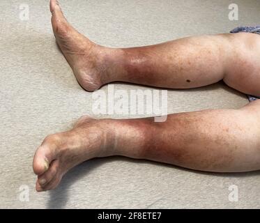 A woman's legs are shown, she is suffering from Chronic Venous Insufficiency with mild cellulitis in her legs. In bed as she rest to relieve heaviness Stock Photo
