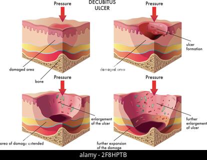 Medical illustration of the stages of the decubitus ulcer, with annotations. Stock Vector