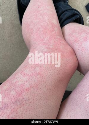mottled skin heat rash hives allergy reaction on knee close-up reference picture of blotchy mottled red skin erythema ab igne also known as EAI Stock Photo