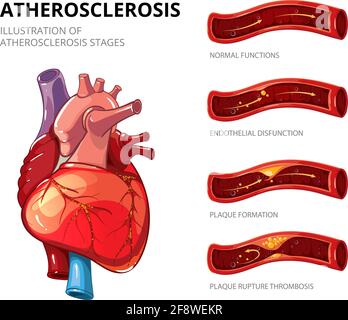 Illustration of Arterial thrombosis is a blood clot that develops to ...