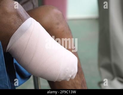 Elastic bandaged below knee amputation Stock Photo