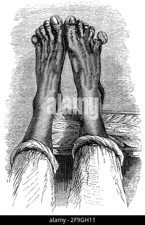 Gangrene of the feet. Illustration of the 19th century. Germany. White background. Stock Photo