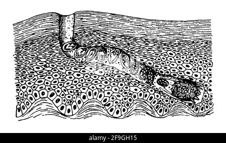 Schematic cross section through a mite duct in the epidermis. Illustration of the 19th century. Germany. White background. Stock Photo