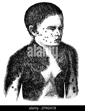 Front view of a four year old partially hairy child. Hypertrichosis. Illustration of the 19th century. Germany. White background. Stock Photo