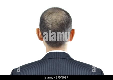 Hair thinning symptom on a man head - sign of hair loss Stock Photo