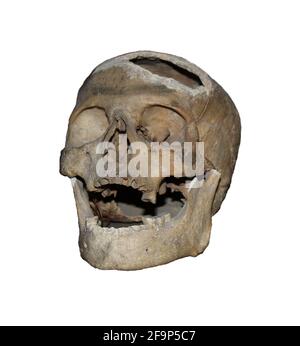 Skull isolated on white background. Old human trepanned skull. Trepanation Stock Photo