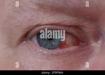 A man's eye. It's a macro- Eye disease, hemorrhage in the eye. Stock Photo