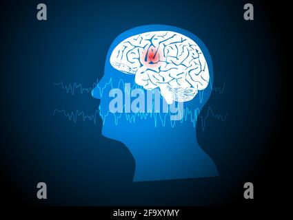 Focal seizure. Illustration of human brain and electroencephalograhy or EEG originating from one regional onset. Stock Vector