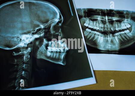 X-ray of human skull in lateral projection and Panoramic dental X-Ray Stock Photo