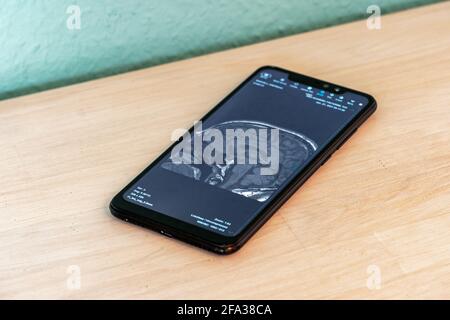 MRI Image of a Human Brain shown on a Smartphone Screen Stock Photo