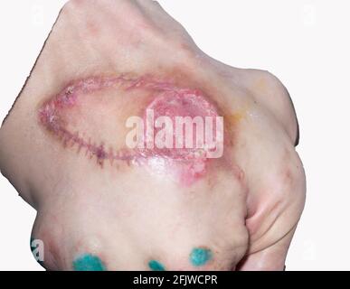 bedsores of the second degree sacrococcygeal region after surgery for plastic skin pressure sores Stock Photo