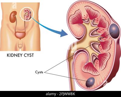 Medical illustration of a kidney with some cysts. Stock Vector