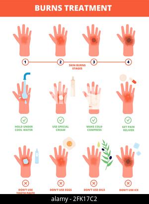 Skin burn. Burned hand treating, protection burns. First aid and treatment, stages of burning. Flat vector medical treat illustration Stock Vector