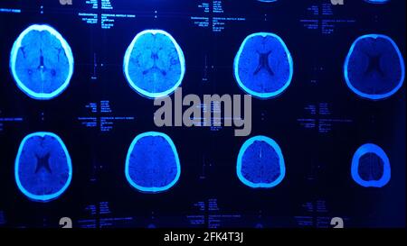 This stock photo shows a magnetic resonance imaging MRI of the brain ...