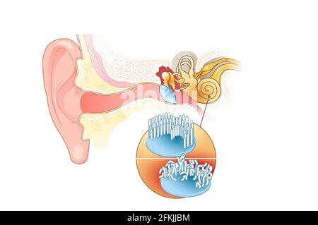 Tinnitus, healthy and damaged hair cells inside cochlea Stock Photo