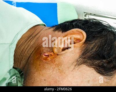 Close up abscess on right face behind the ear of man Stock Photo