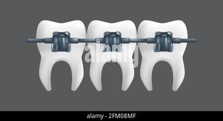 Teeth with metal braces. Orthodontic treatment concept. 3d realistic vector illustration of a dental ceramic model isolated on a grey background Stock Vector