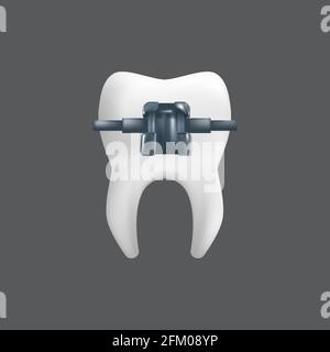 A tooth with a metal brace. Orthodontic treatment concept. 3d realistic vector illustration of a dental ceramic model isolated on a grey background Stock Vector