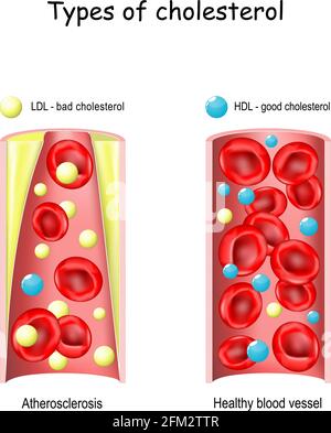 Cholesterol ldl 4 Simple