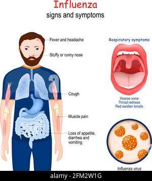 Influenza. the flu. Signs and symptoms of infectious disease. Magnification of influenza viruses. Close up of human mouth with red and swollen tonsils Stock Vector